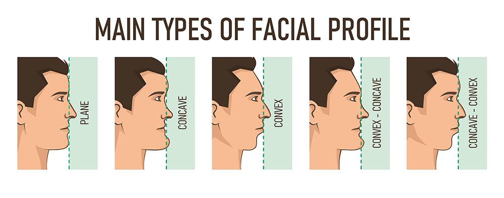 facial traum profile view